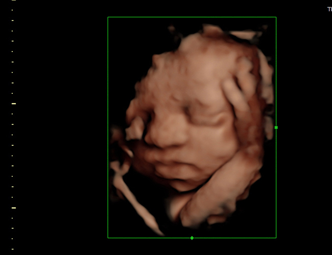 3D ultrasound image at 29 weeks